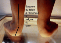 Rôles des semelles orthopédiques chez les pieds plats valgus chez l'enfant. 