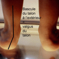 Roles Des Semelles Orthopediques Chez Les Pieds Plats Valgus Chez L Enfant Roles Des Semelles Orthopediques Chez Les Pieds Plats Valgus Chez L Enfant